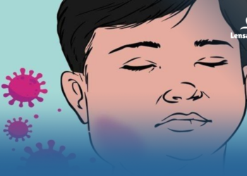 gambar mengenal penyakit gondongan dari penularan infeksi yang diwaspadai