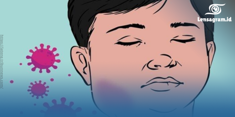 gambar mengenal penyakit gondongan dari penularan infeksi yang diwaspadai